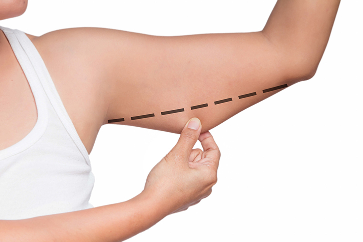 Arm Lift Surgery