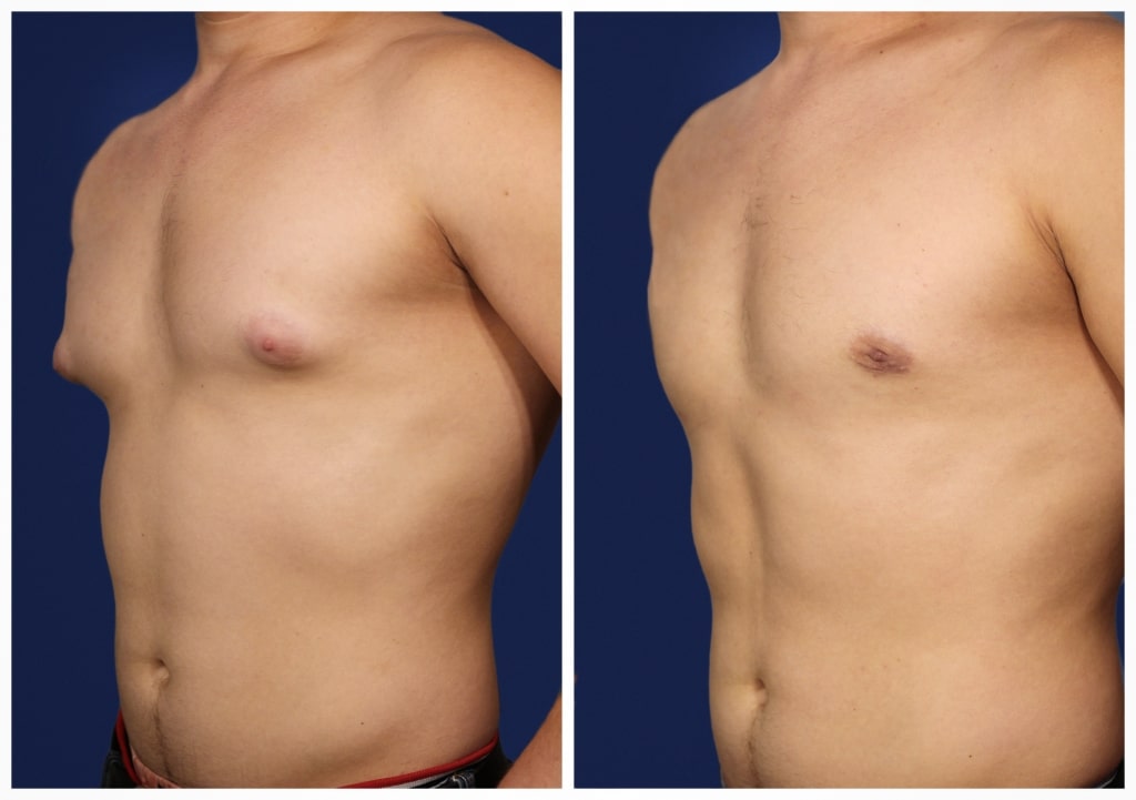 Gynecomastia
