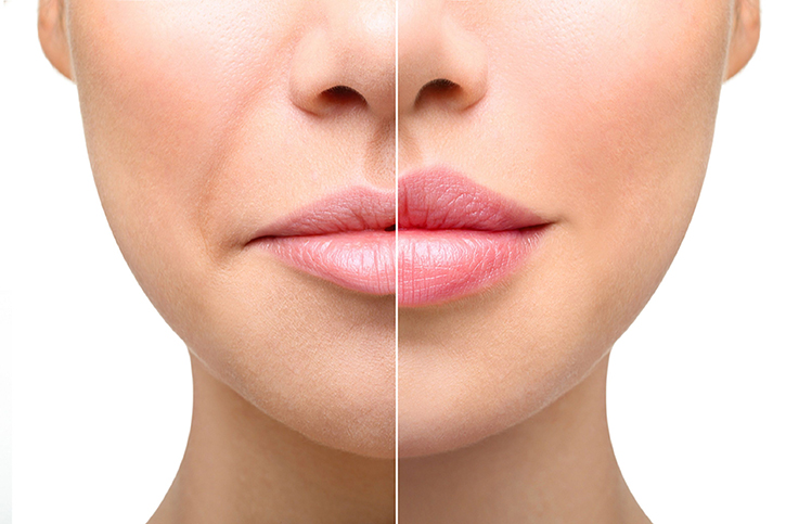 Lip Lift Surgery