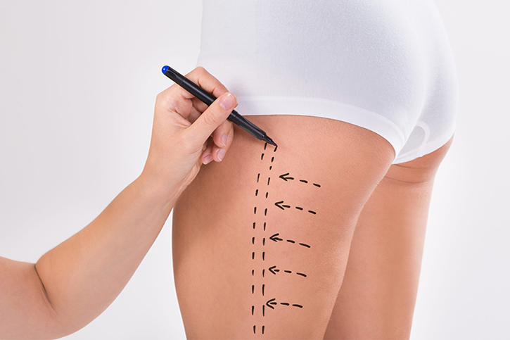 Thigh Lift Surgery