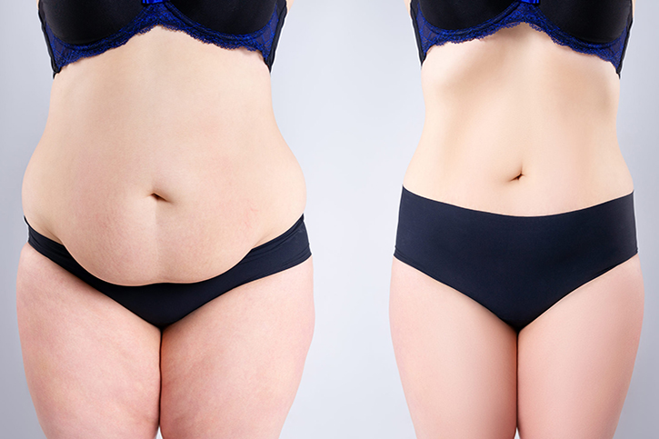 Tummy Tuck